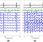 Darstellung klinischer Signale bei Vorhofflimmern: (a) zeigt Rauschen und starke VFF-Komponenten auf, die durch Standardmethoden nicht entfernt werden können (b). Nach Anwendung der Dipolmodell-basierten VFF-Entfernung sind die VFF-Komponenten deutlich geringer (c). In der unipolaren Messung (d) kann das VFF effizient entfernt werden. (Bild: Institut für Biomedizinische Technik / KIT)