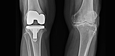 Medical implants, such as an artificial knee joint shown here, require special coatings for sterile use. With the new UV-catalyzed process, special biomimetic coatings are possible that enhance the antibacterial effect and can even contribute to the healing process. (Image: Joel Bubble Ben / Adobe Stock)