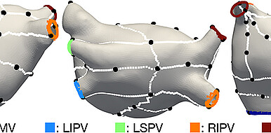 Modellierung mit dem Verfahren des KIT: Die gesammelten medizinischen Daten werden automatisiert zu einem Vorhofmodell zusammengeführt. Die Vorhoföffnungen sind farblich gekennzeichnet und die Landmarken automatisch markiert um eine bessere Orientierung für die Bestimmung der Ablationsstelle zu gewährleisten. (Bild: Institut für Biomedizinische Technik / KIT)