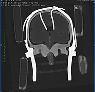 CT image of the skull used to calculate the three-dimensional models. (Image: Health Robotics and Automation / KIT)