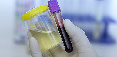 Die neuartigen Chemosensoren kann zur Früherkennung von Krebsarten und endokrinen Störungen eingesetzt werden, indem er abnormale Neurotransmitterprofile im Urin oder Blut erkennt. (Bild: Benchamat / Adobe Stock) 