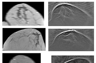 Breast cancer detection by 3D Ultrasonic Computer Tomography
